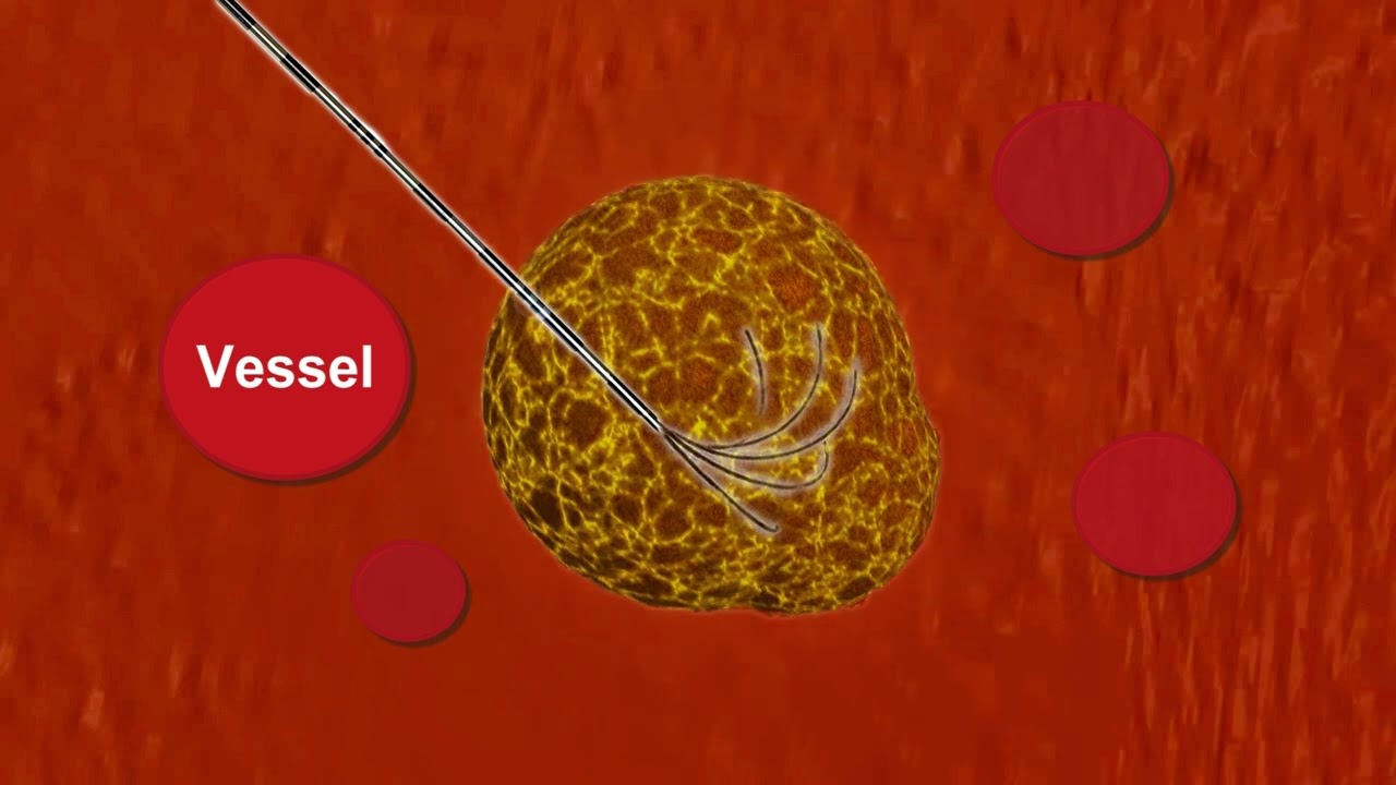 Intelligent Radio Frequency Ablation (iRFA) Video