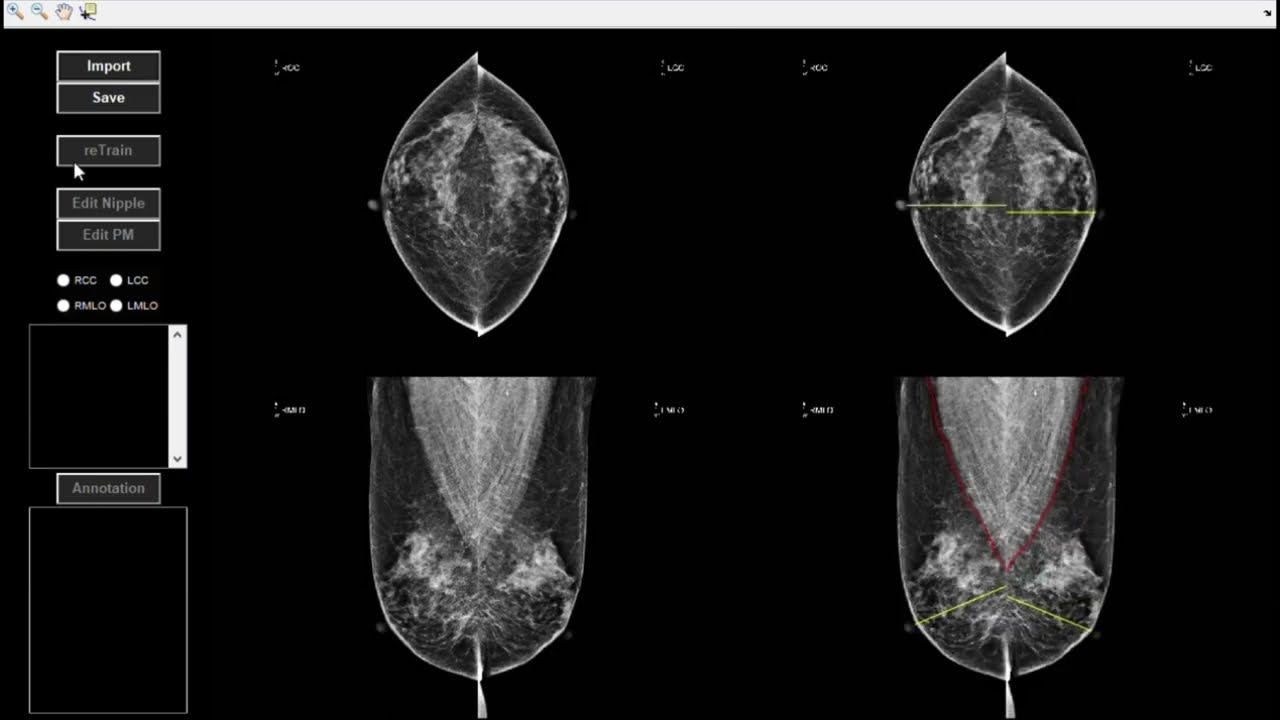 4D (3D+Dissimilar) Printed of Solid State Process Video
