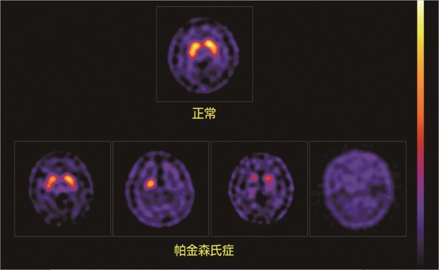 圖二：（上）正常受試者的多巴胺掃描影像。（下）若紋狀體型態不對稱，一邊攝取值較低，且豆狀的紋狀體尾部缺損較明顯時，可能為帕金森氏症