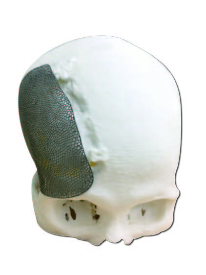 多孔醫材－頭蓋骨