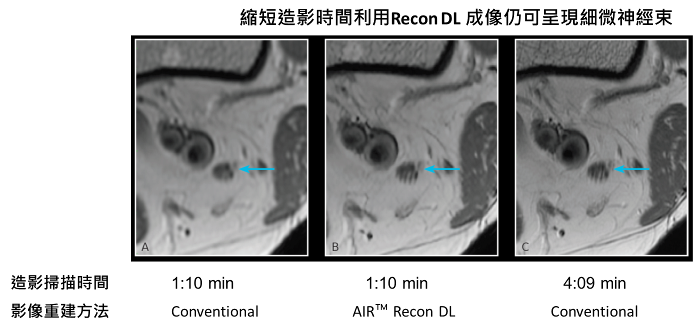 圖3  GE Healthcare 之MRI造影重建AI演算法減少掃描時間仍可清晰成像