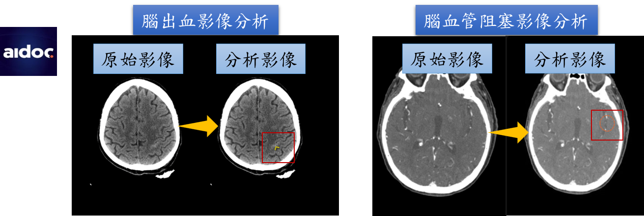 圖3 Aidoc開發之腦部血管CT影像掃描的AI分析軟體
