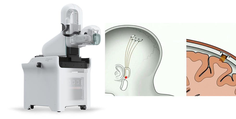 圖2 Neuralink主要產品Telepathy。左：R1 Robot手術機器人；中：N1 Implant及外部連接位置；右：N1 Implant植入位置